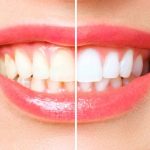 Mitos y verdades sobre el blanqueamiento dental.