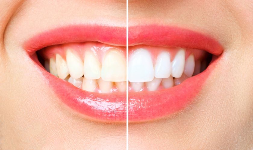 Mitos y verdades sobre el blanqueamiento dental.