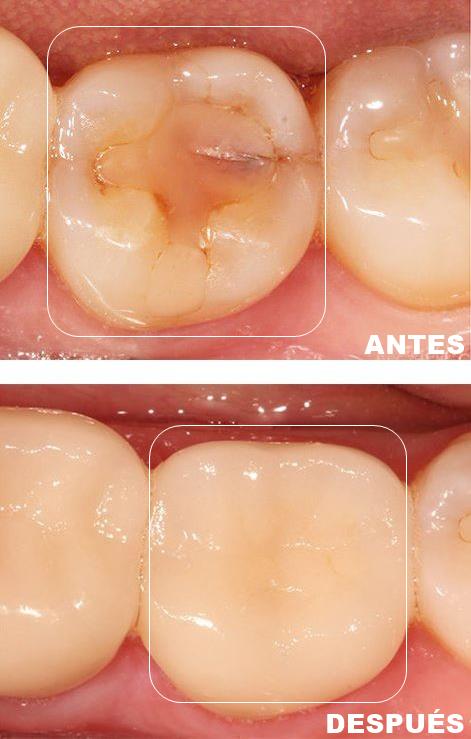 Fundas - coronas dentales | Antes - después