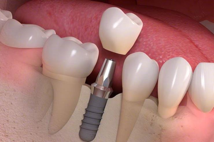 Especialistas en implantes dentales en Villanueva del Pardillo | Madrid Noroeste