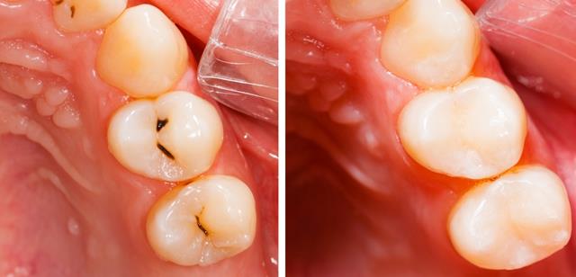 Empaste dental | Antes - Después