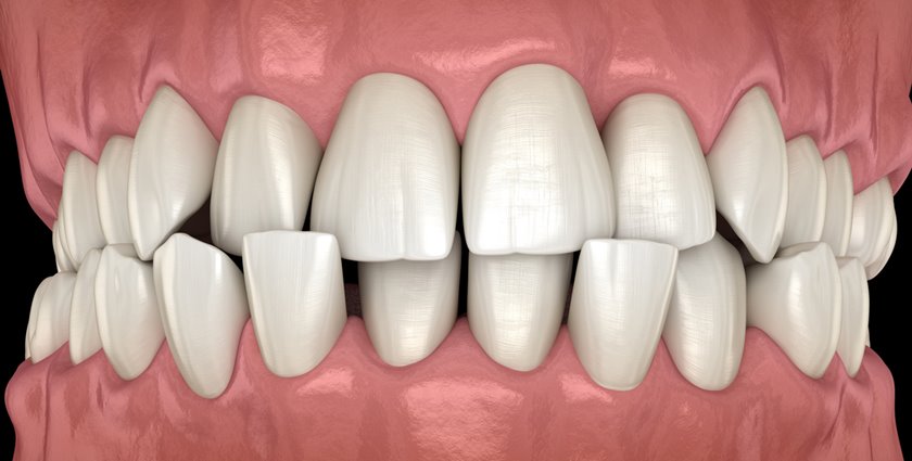 Efectos del chupete dientes: riesgos y beneficios de uso