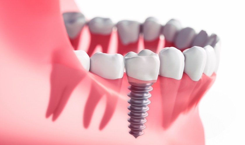 Mitos sobre los implantes dentales.