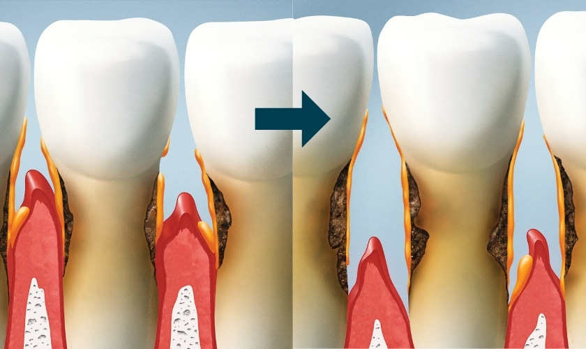 Enfermedad periodontal avanzada.