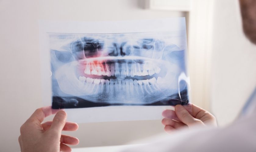 Flemón dental: dentista mirando radiografía