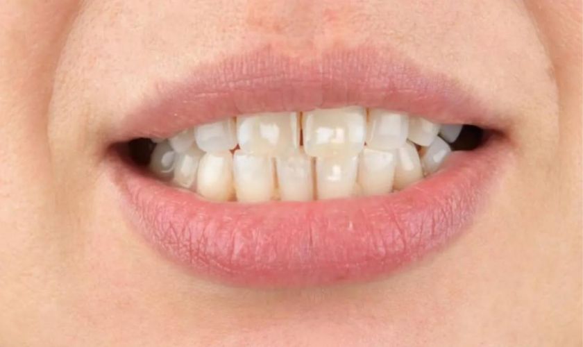 Lesiones de mancha blanca vinculadas a la ortodoncia.