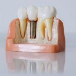 Contraindicaciones de los implantes dentales