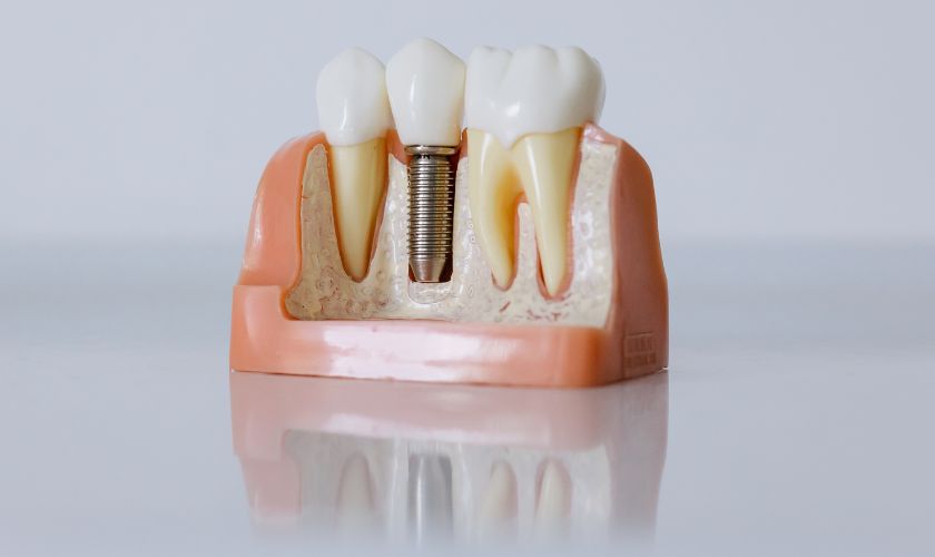 10 contraindicaciones de los implantes dentales