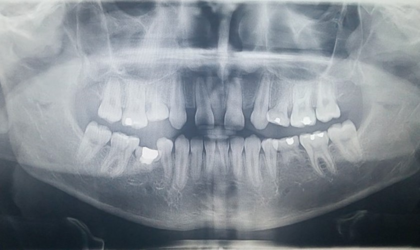 Agenesia dental: radiografía que muestra caso de oligodoncia.