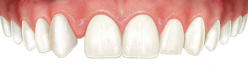 Agenesia dental: caso de hipodoncia.