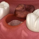 ¿Qué es la alveolitis dental?