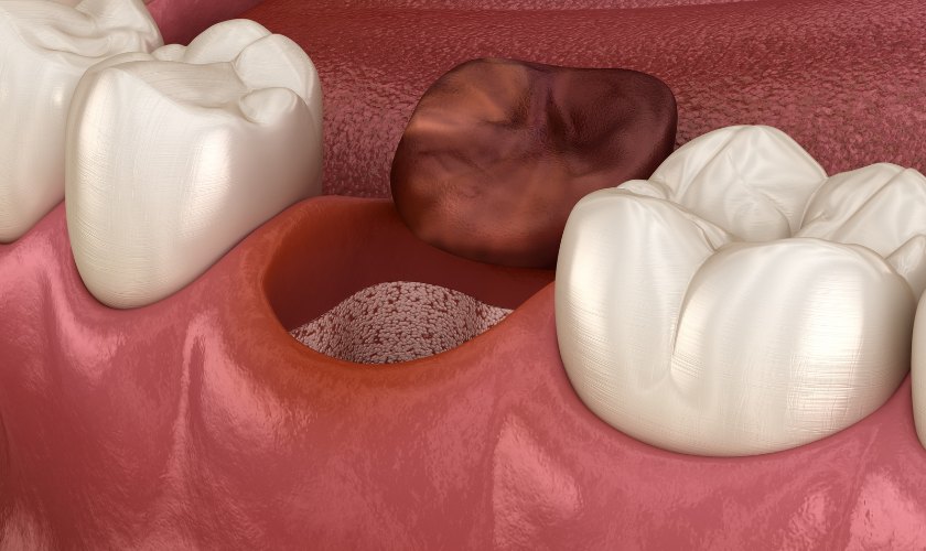 ¿Qué es la alveolitis dental?