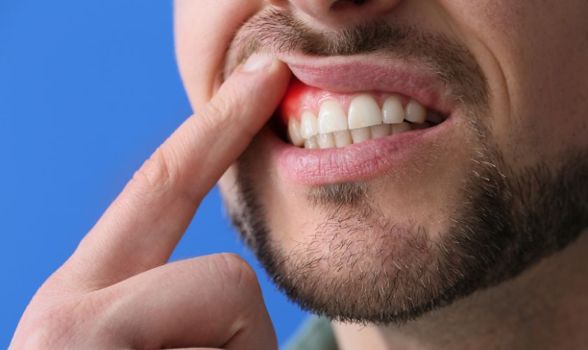 La acumulación de bacterias derivada del hábito de morderse las uñas puede provocar gingivitis y periodontitis.