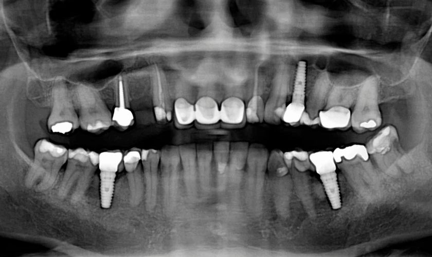 ¿Puedo ponerme un implante dental si tengo poco hueso?