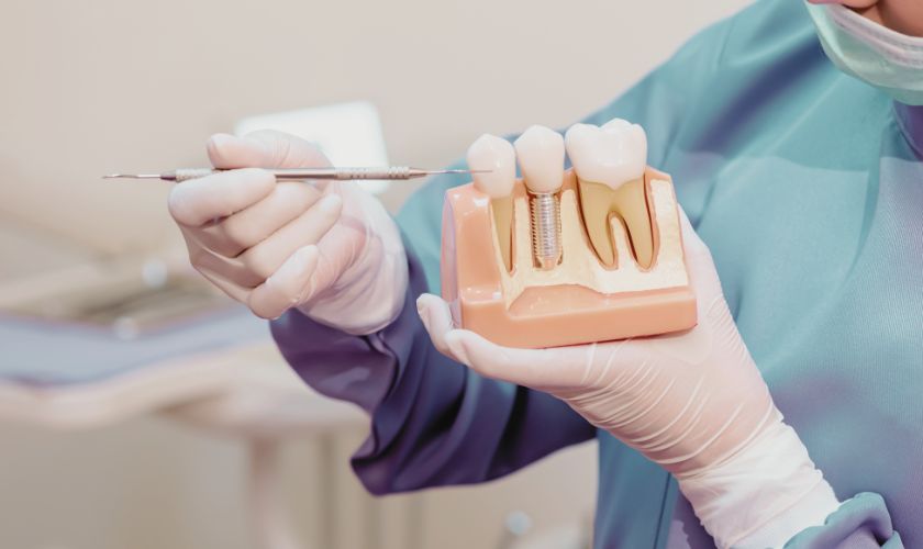 Regeneración ósea guiada para implantes: cómo se crea “hueso nuevo” paso a paso