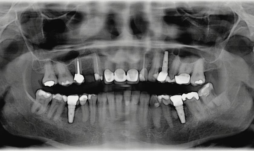 Revisión radiográfica para controlar implantes dentales