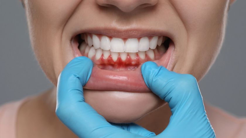 Sangrado de encías como señal para acudir a una revisión dental Sangrado de encías como señal para acudir a una revisión dental
