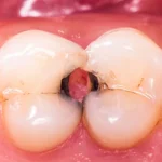 Caries entre los dientes
