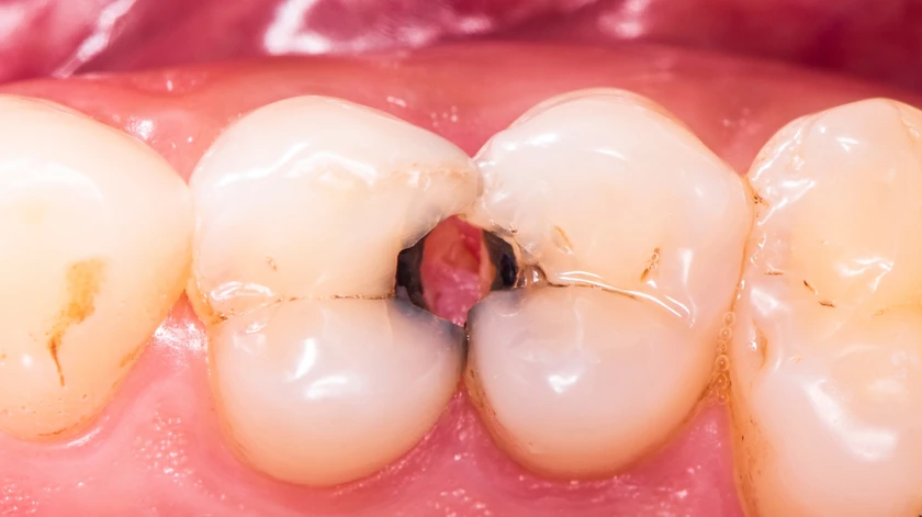 Caries entre los dientes