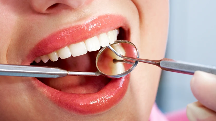 Revisión dental para detectar caries entre dientes Revisión dental para detectar caries entre los dientes